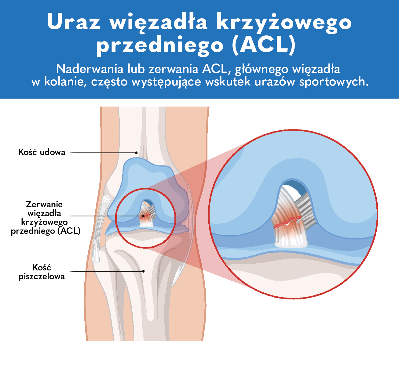 uraz wiezadla krzyzowego acl ortopeda warszawa centrum
