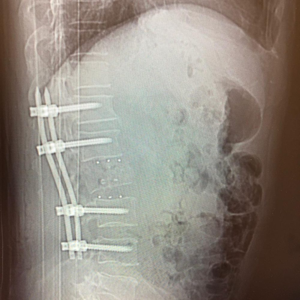 Operację złamań ktęgosłupa z wykorzystaniem robota operacyjnego 2