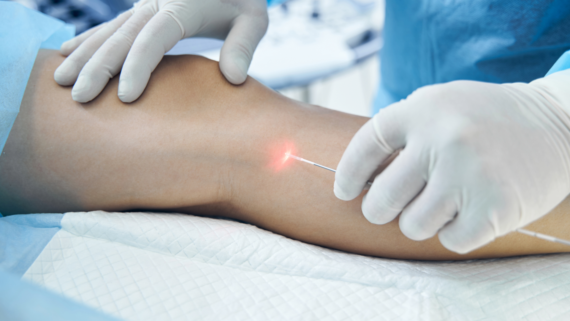 Laserowe usuwanie zylkaow warszawa life medical center