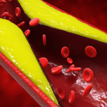 jak obnizyc cholesterol WARSZAWA LIFE MEDICAL CENTER (1)
